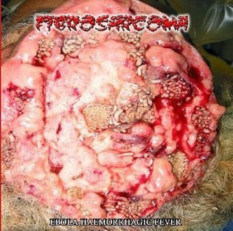 Fibrosarcoma