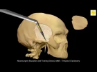 Neurosurgery 3D Animation Video : Temporal Craniotomy