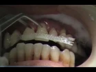 QUARTZ SPLINT WOVEN - шинирование подвижных зубов кварцевой шинирующей лентой