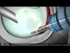 Операция Банкарта, привычный вывих плеча (Bankart Repair Surgical Technique Animation)