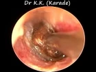 First Time Ear Wax Removal In Small Child : Narrow Hairy Ear Canals with Earwax Stuck to Eardrum