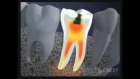 What is a Tooth Abscess? - California Dental Group