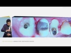 Dr. Victor Clavijo "Prosthetic Options for Posteriors and Anteriors - Procedural Aspect"