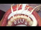 Интересный способ фиксации ретейнера с помощью зубных нитей. Retanium Splint Placement (Orthodontics)