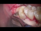 Estrazione dente del giudizio inferiore. Lower third molar extraction
