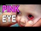 PINK EYE: Live Diagnosis (Conjunctivitis)