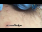 Шугаринг обучение Омск Мастер класс Удаление вросших волос Removing ingrown hairs Токмаков