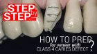 How to prep for veneer with class 4 caries defect? Step-by-step video