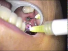 DR. GERARD CUOMO Implant Dentistry June's Case 3  Boca Raton Florida
