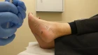 Injection - plantar fasciitis and tarsal tunnel syndrome - 2 injections