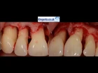 Periodontal Surgery with Regeneration for Upper Teeth