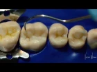 Clase I en dientes posteriores  - Filling a class I cavity