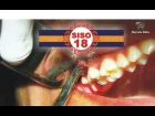 EXTRAÇÃO DE SISO 18 / wisdom tooth Extraction Surgery